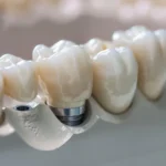 Protesi nella gestione delle malocclusioni e dei disturbi occlusali 2