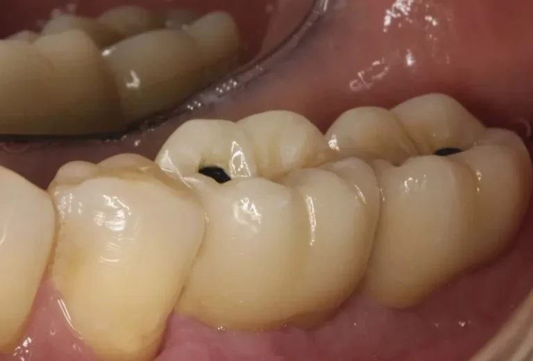 cemento dei denti