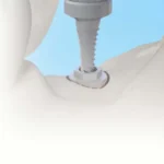 osstem implant co ltd
