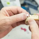 Differenze tra impianto dentale e ponte dentale
